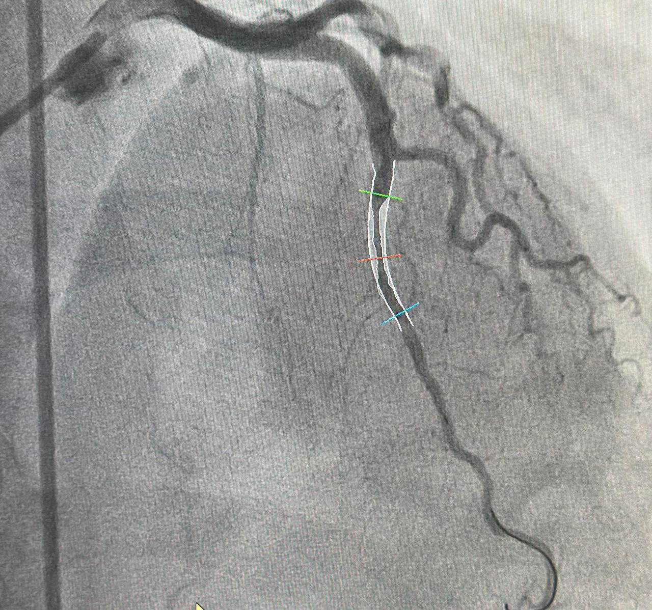 Женщина «сбежала от инфаркта» в больницу