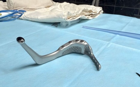 Донские хирурги имплантировали женщине новую челюсть взамен разрушенной онкологией