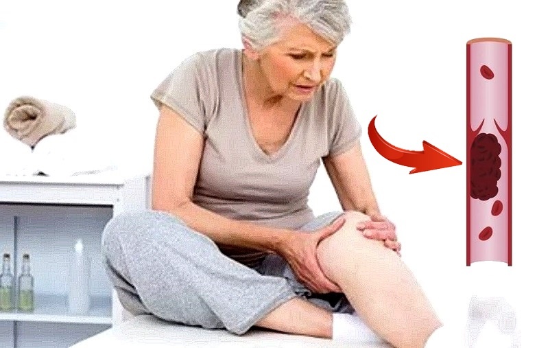 Тромбы после 60 лет: что нужно знать каждому