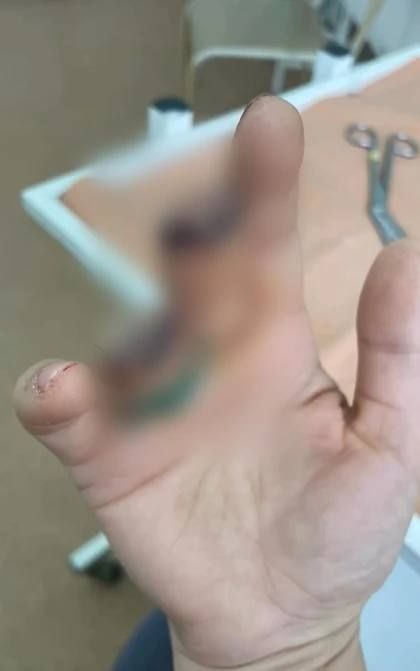 В Шахтах 30-летие Дарьи Картошовой обернулось кошмаром: в кафе на девушку рухнула столешница, отрубив фаланги двух пальцев, как гильотиной