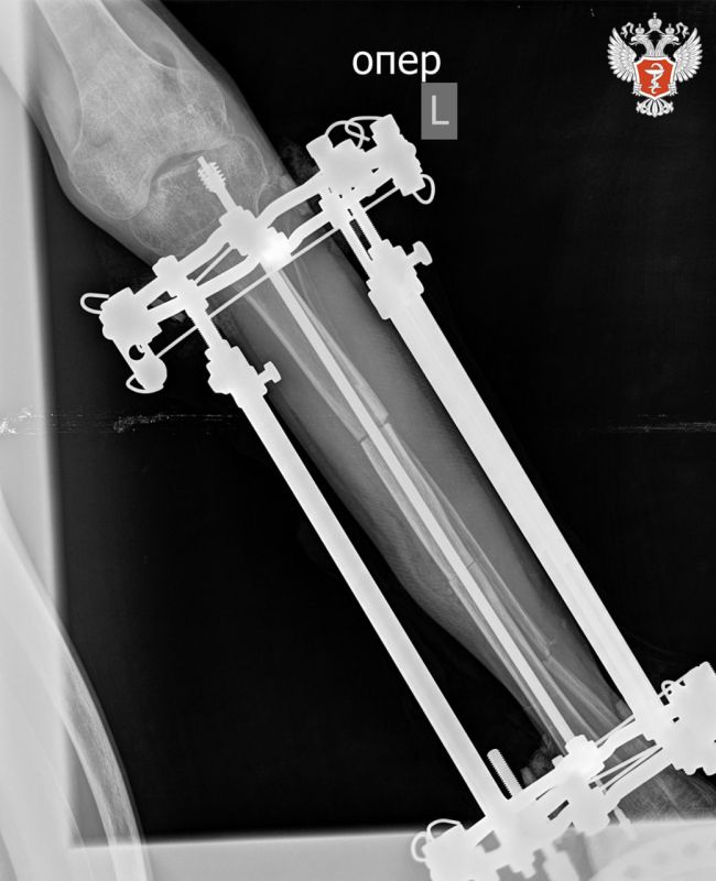 Врачи НМИЦ травматологии и ортопедии им. ак. Г. А. Илизарова Минздрава России ставят на ноги пациентов с «хрустальной болезнью»