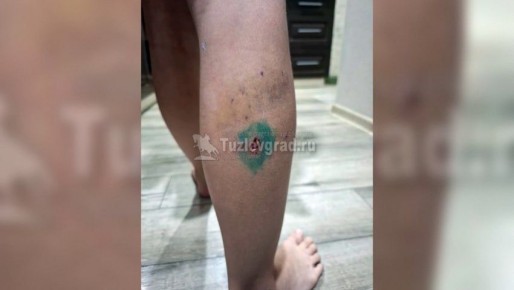 На школьницу напали бездомные собаки и прокусили ногу в Новочеркасске