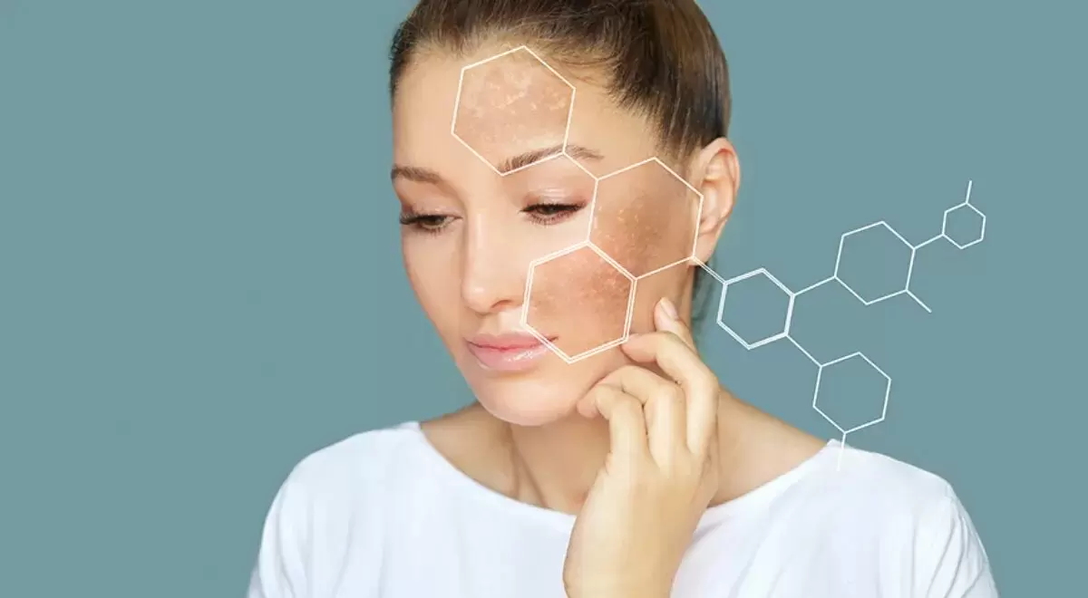 Пигментные пятна: Причины и решения