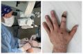 Ростовские врачи пришили пациентам большой и указательный пальцы
